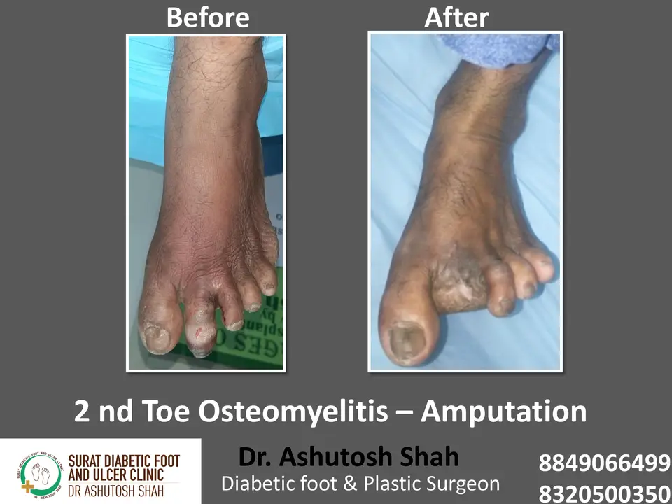 Diabetic Foot  PPT sunita.pptx-38.webp